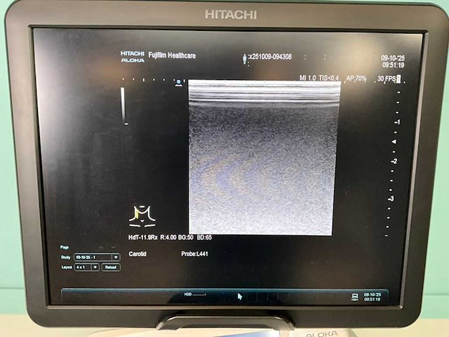 Hitachi - arietta v70 - echo-apparaat - 2016 - afbeelding 13 van  17