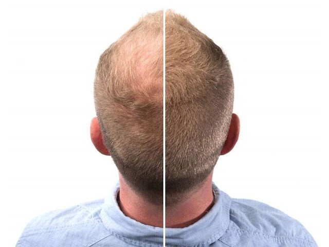 Partij haargroei cosmetica - circa 25 pallets re-hair - afbeelding 6 van  16