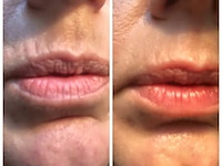 Smooth skin laser, iluminage, wit - afbeelding 4 van  5