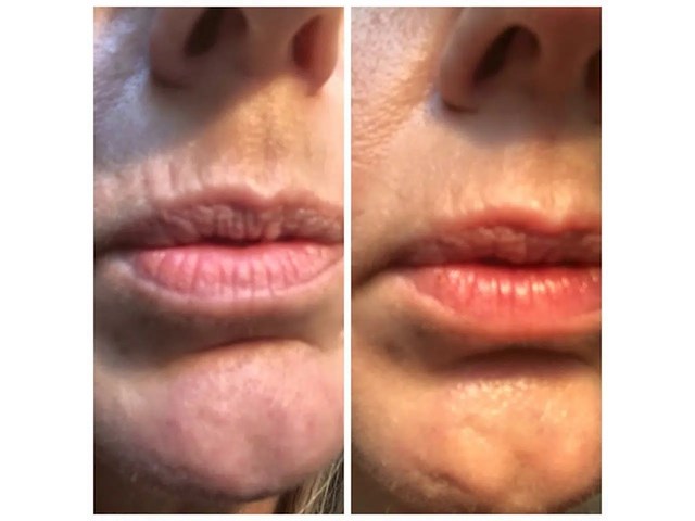 Smooth skin laser, iluminage, wit - afbeelding 4 van  5